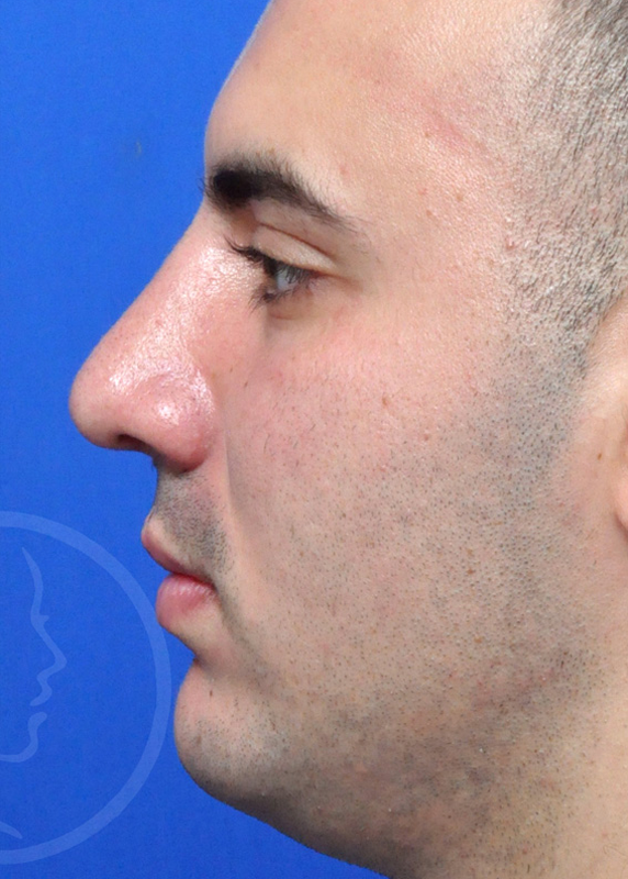 Rhinoplasty Before and After Pictures Jacksonville, FL