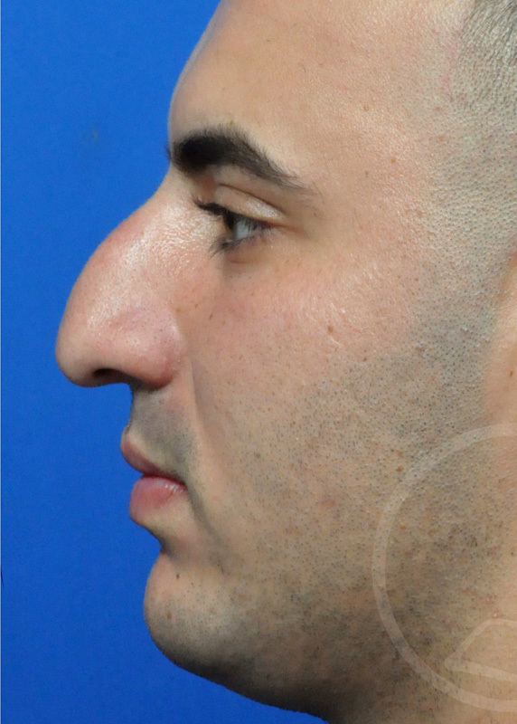 Rhinoplasty Before and After Pictures Jacksonville, FL