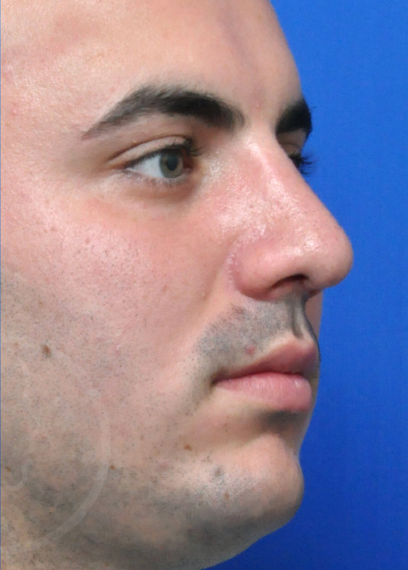 Rhinoplasty Before and After Pictures Jacksonville, FL