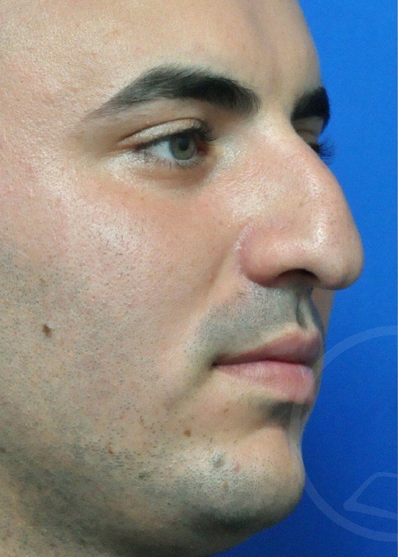 Rhinoplasty Before and After Pictures Jacksonville, FL