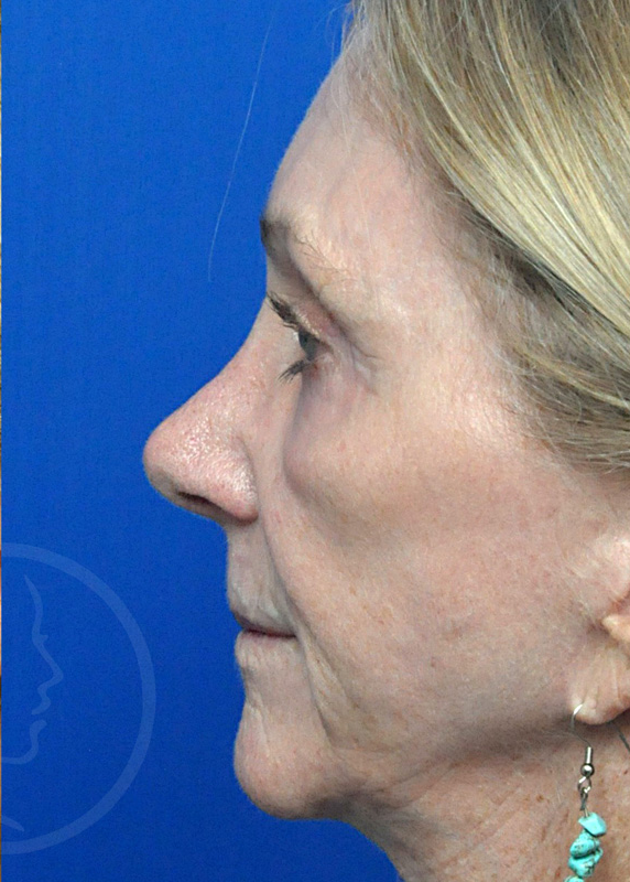 Rhinoplasty Before and After Pictures Jacksonville, FL