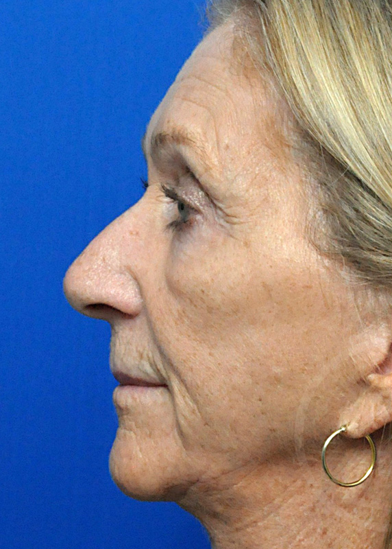 Rhinoplasty Before and After Pictures Jacksonville, FL