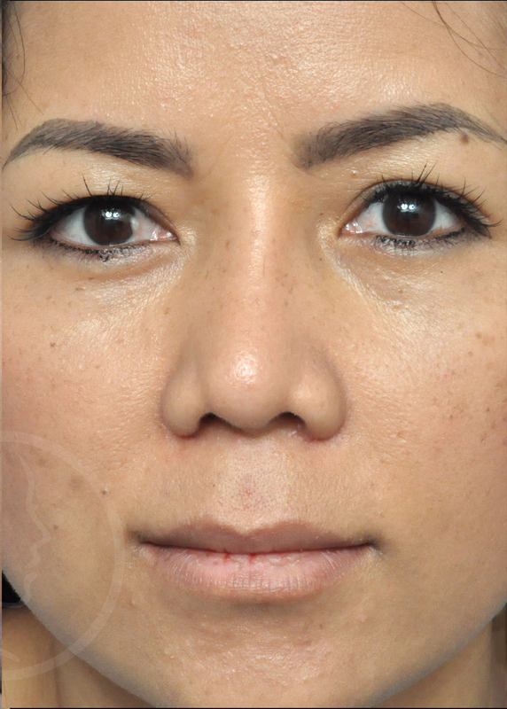 Rhinoplasty Before and After Pictures Jacksonville, FL