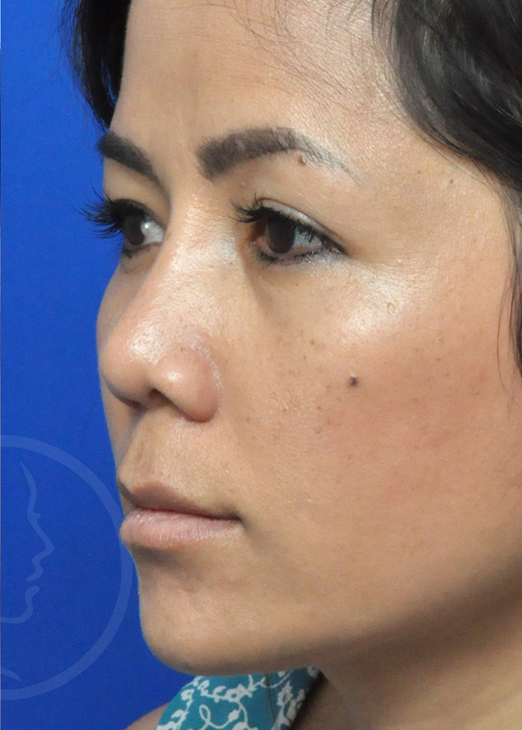 Rhinoplasty Before and After Pictures Jacksonville, FL