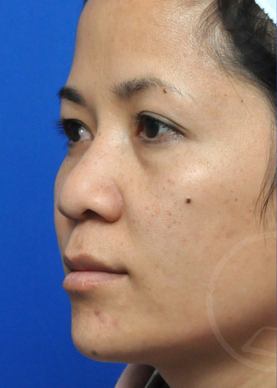 Rhinoplasty Before and After Pictures Jacksonville, FL