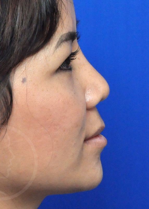 Rhinoplasty Before and After Pictures Jacksonville, FL