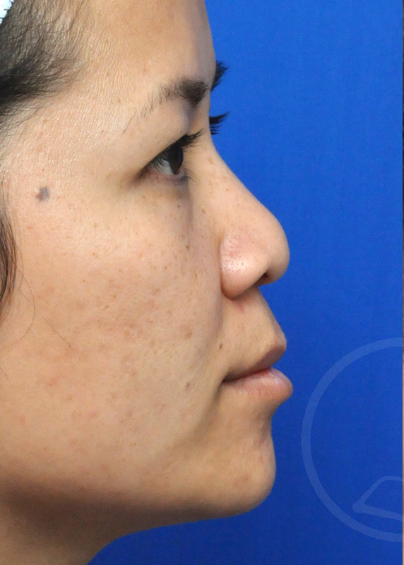 Rhinoplasty Before and After Pictures Jacksonville, FL