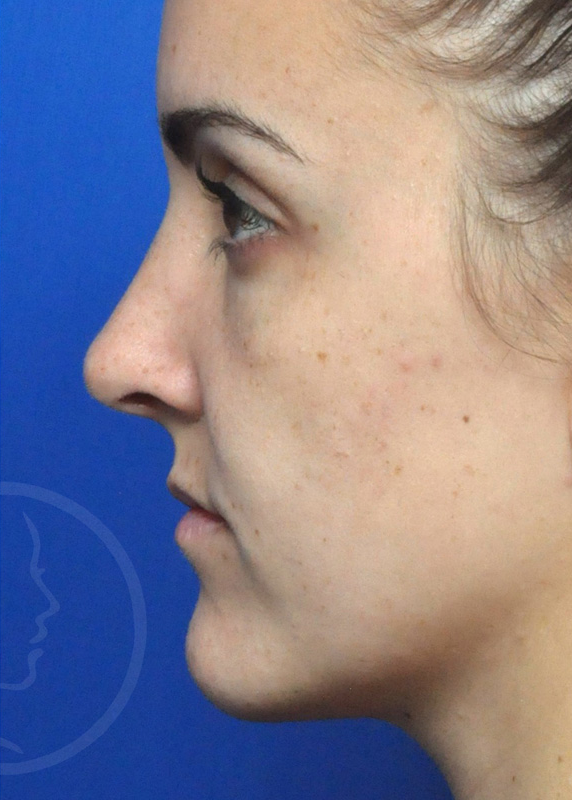 Rhinoplasty Before and After Pictures Jacksonville, FL