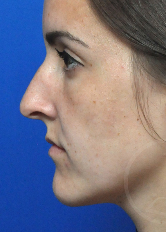 Rhinoplasty Before and After Pictures Jacksonville, FL