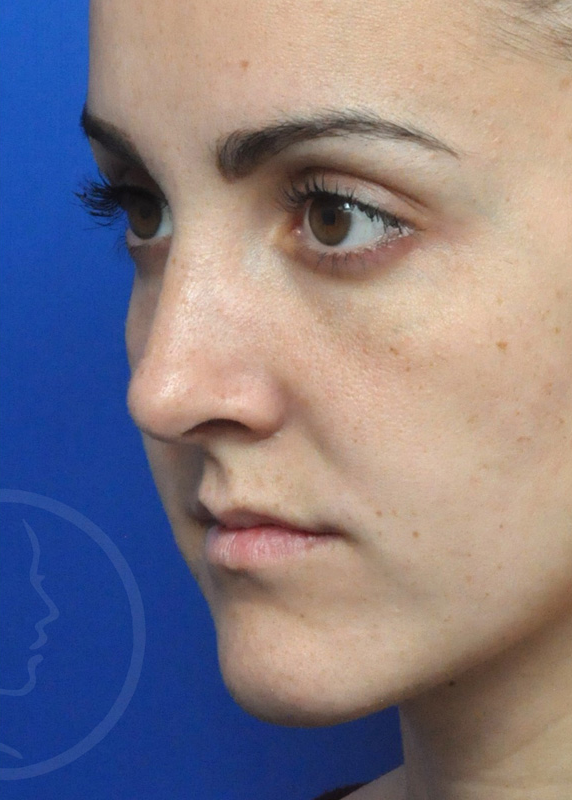 Rhinoplasty Before and After Pictures Jacksonville, FL