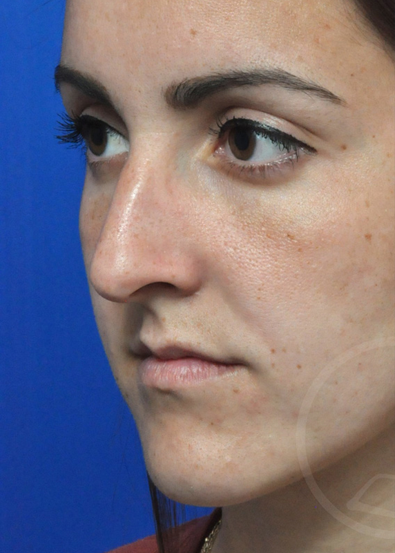 Rhinoplasty Before and After Pictures Jacksonville, FL