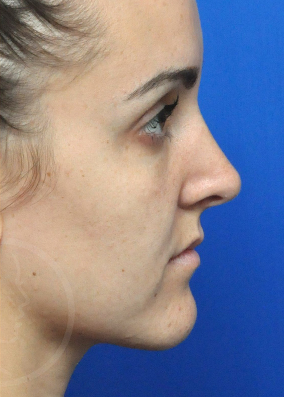 Rhinoplasty Before and After Pictures Jacksonville, FL