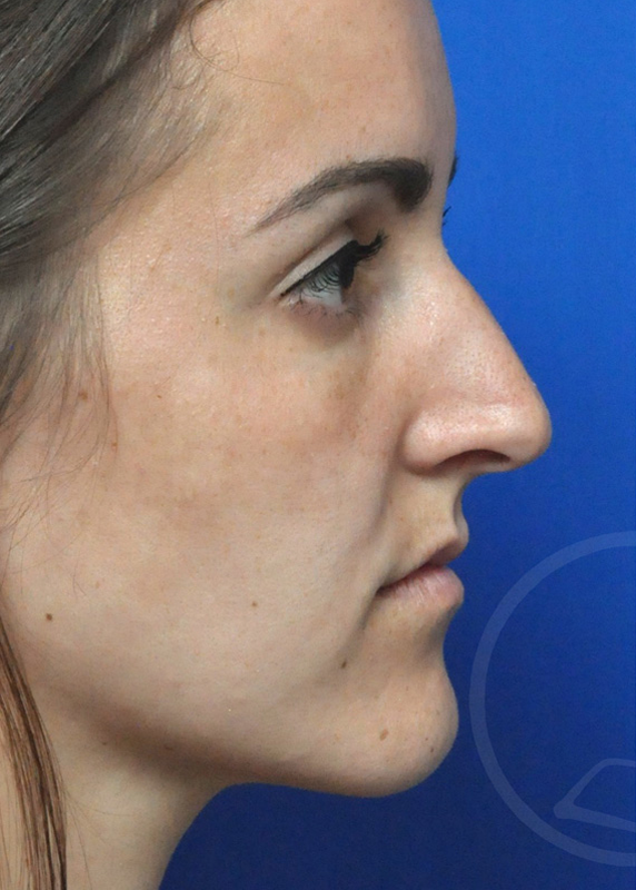 Rhinoplasty Before and After Pictures Jacksonville, FL