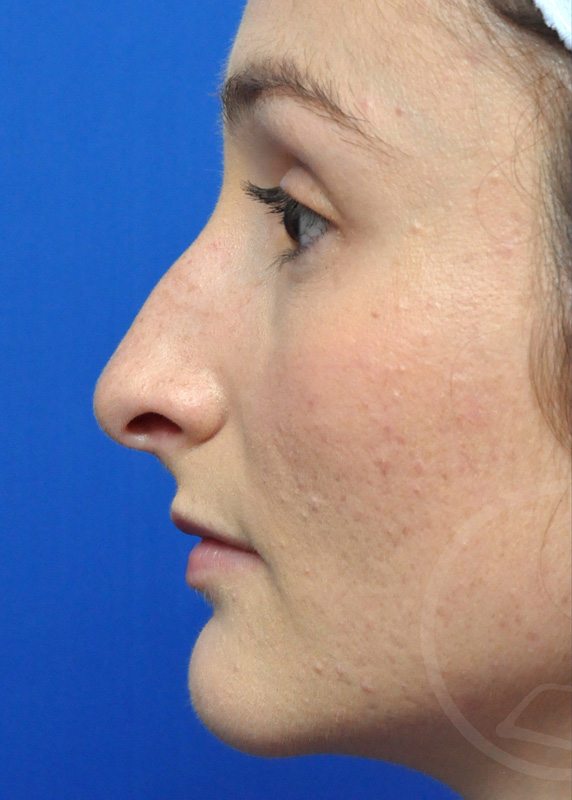 Rhinoplasty Before and After Pictures Jacksonville, FL