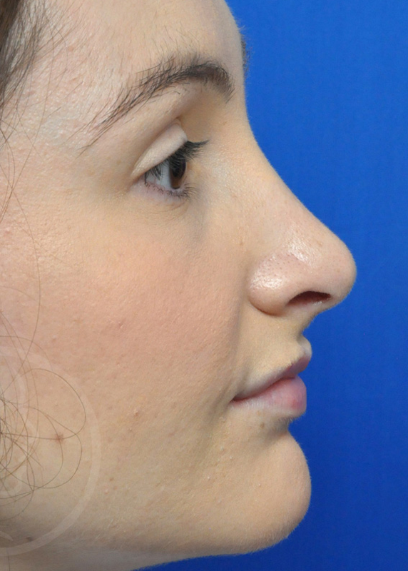 Rhinoplasty Before and After Pictures Jacksonville, FL