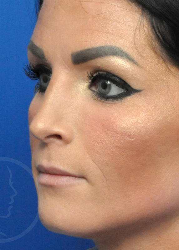 Rhinoplasty Before and After Pictures Jacksonville, FL