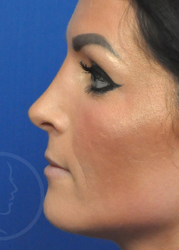 Rhinoplasty Before and After Pictures Jacksonville, FL