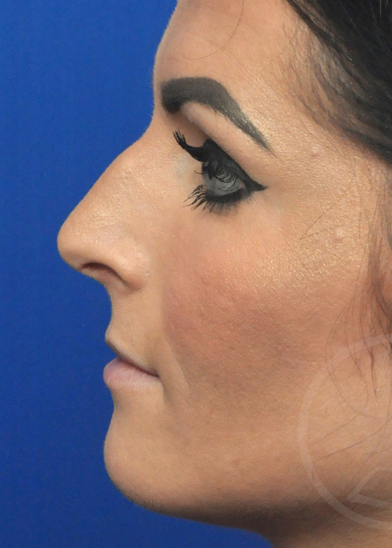 Rhinoplasty Before and After Pictures Jacksonville, FL