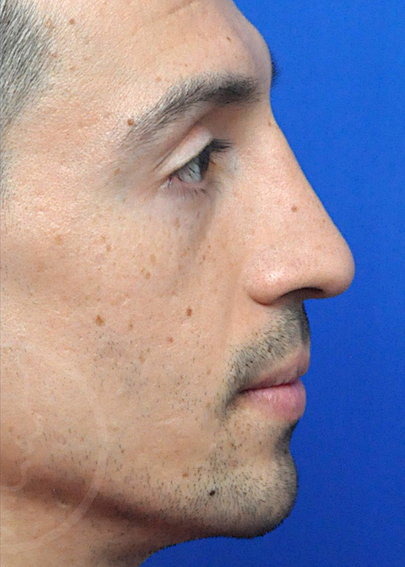 Rhinoplasty Before and After Pictures Jacksonville, FL