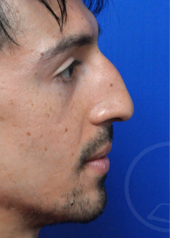 Rhinoplasty Before and After Pictures Jacksonville, FL