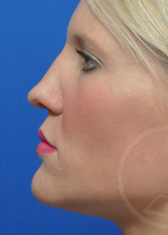 Rhinoplasty Before and After Pictures Jacksonville, FL