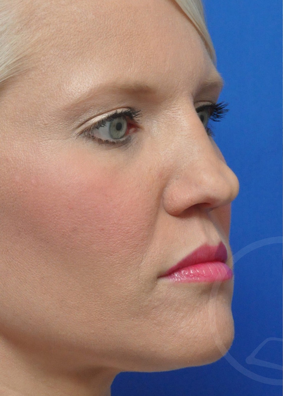 Rhinoplasty Before and After Pictures Jacksonville, FL