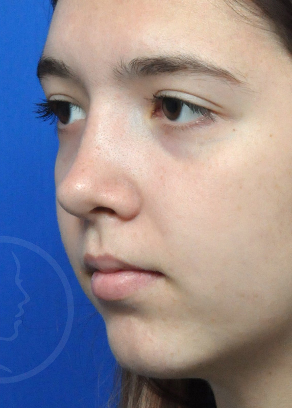 Rhinoplasty Before and After Pictures Jacksonville, FL