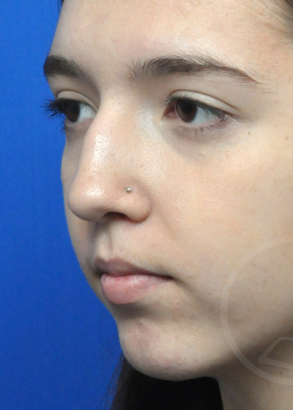 Rhinoplasty Before and After Pictures Jacksonville, FL