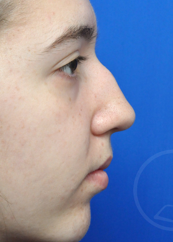 Rhinoplasty Before and After Pictures Jacksonville, FL