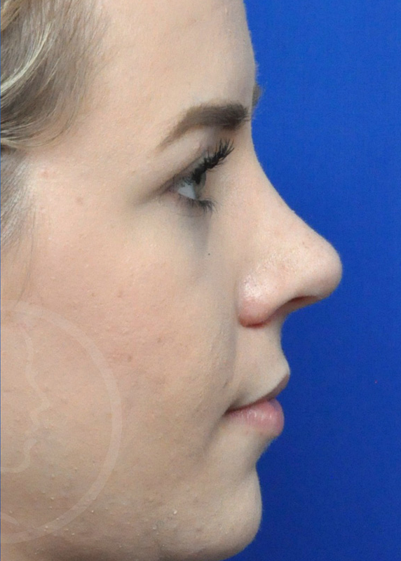 Rhinoplasty Before and After Pictures Jacksonville, FL