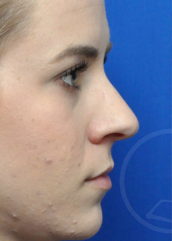 Rhinoplasty Before and After Pictures Jacksonville, FL