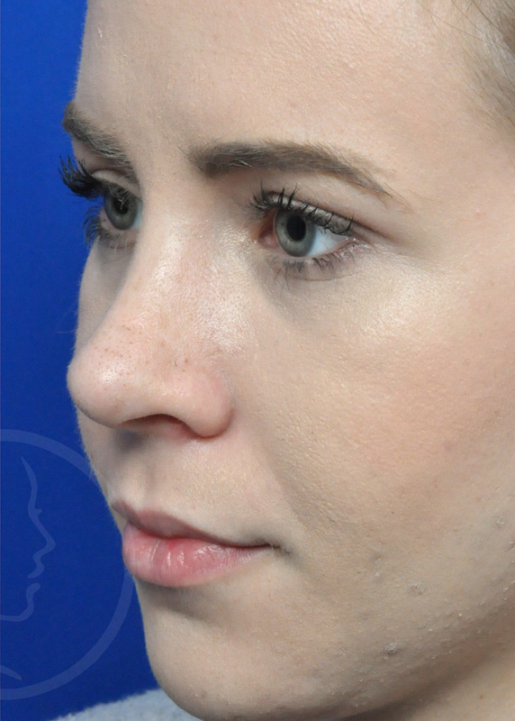 Rhinoplasty Before and After Pictures Jacksonville, FL