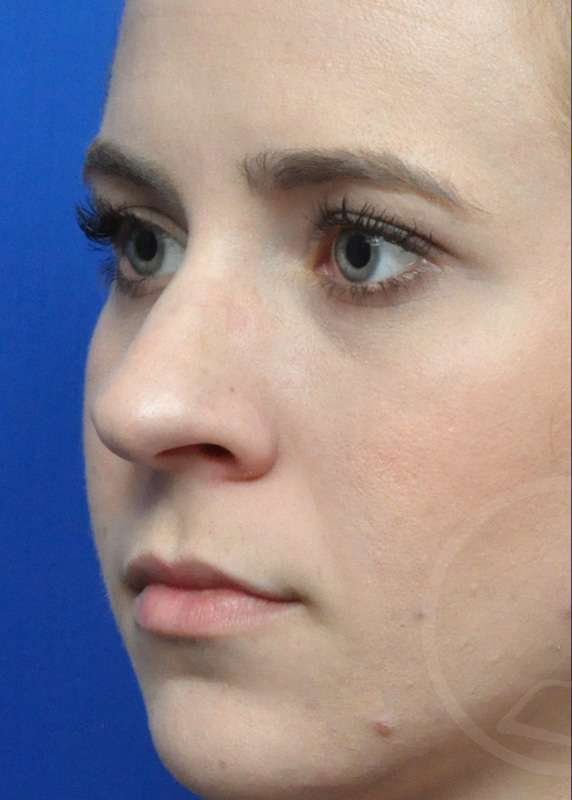 Rhinoplasty Before and After Pictures Jacksonville, FL