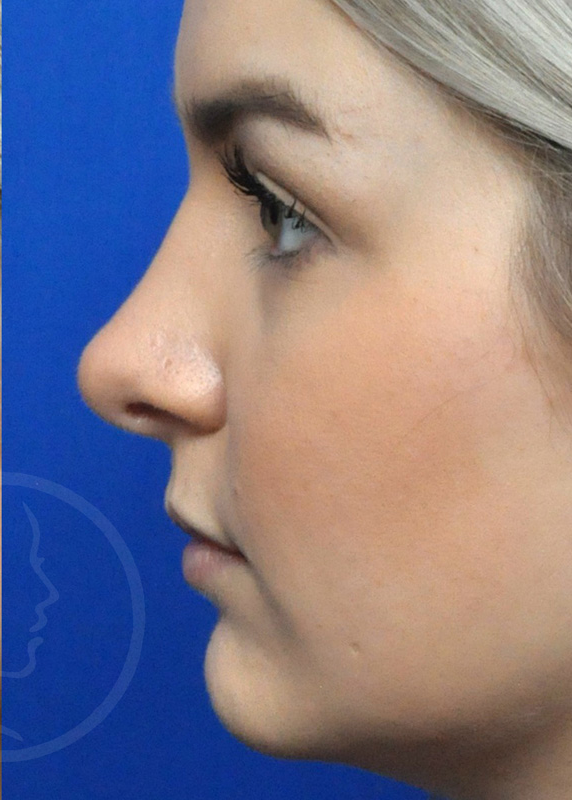 Rhinoplasty Before and After Pictures Jacksonville, FL