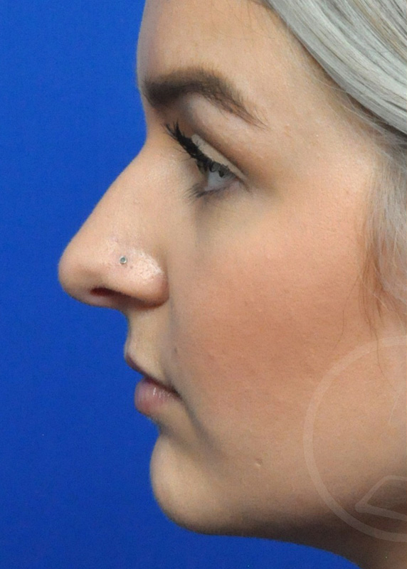 Rhinoplasty Before and After Pictures Jacksonville, FL