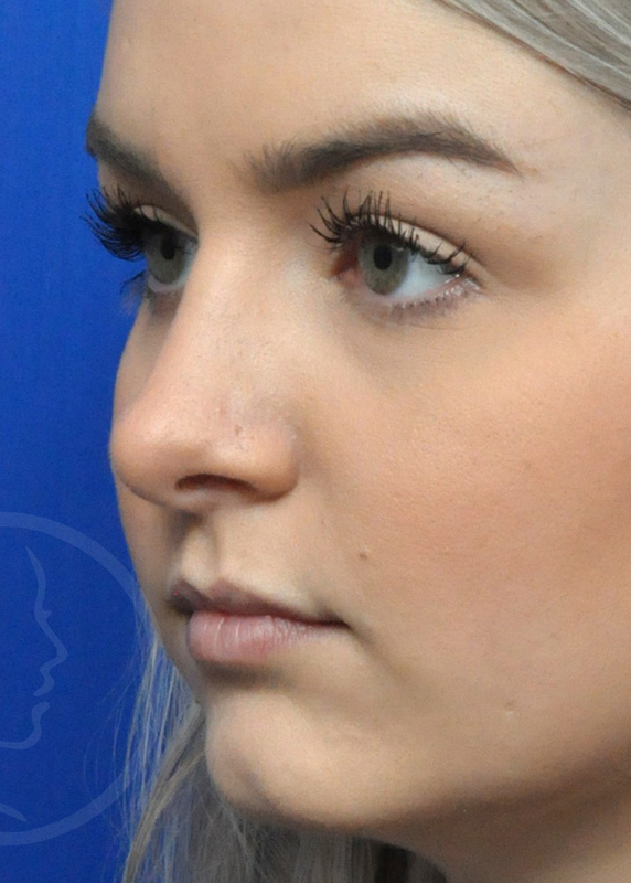 Rhinoplasty Before and After Pictures Jacksonville, FL