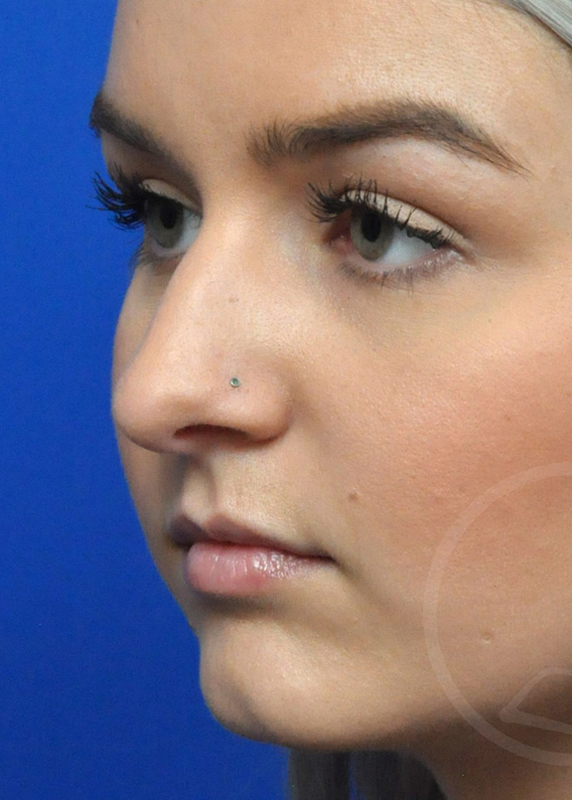 Rhinoplasty Before and After Pictures Jacksonville, FL