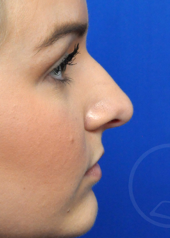 Rhinoplasty Before and After Pictures Jacksonville, FL