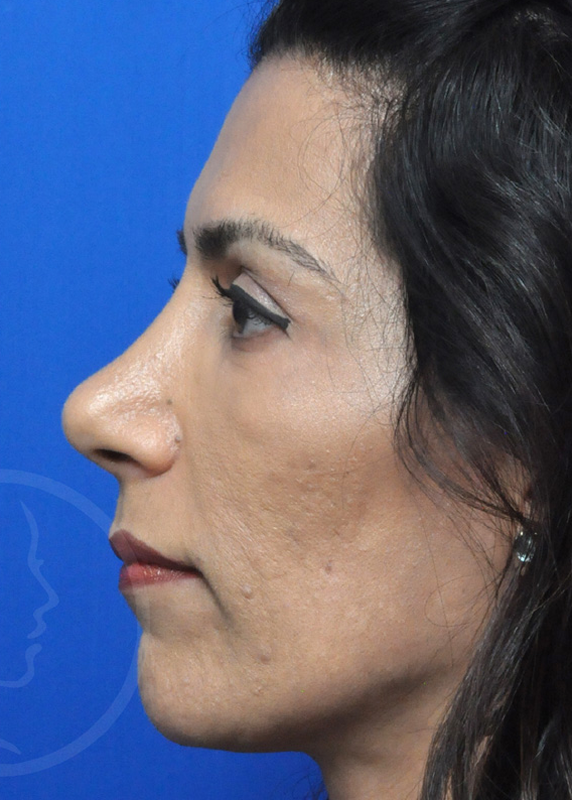 Rhinoplasty Before and After Pictures Jacksonville, FL