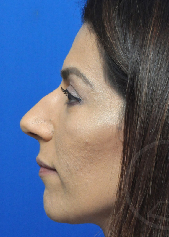 Rhinoplasty Before and After Pictures Jacksonville, FL