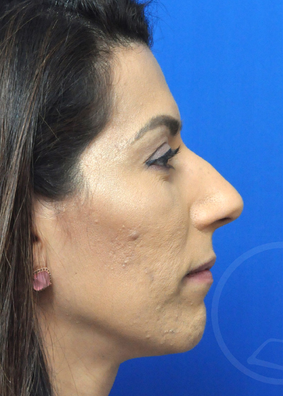 Rhinoplasty Before and After Pictures Jacksonville, FL