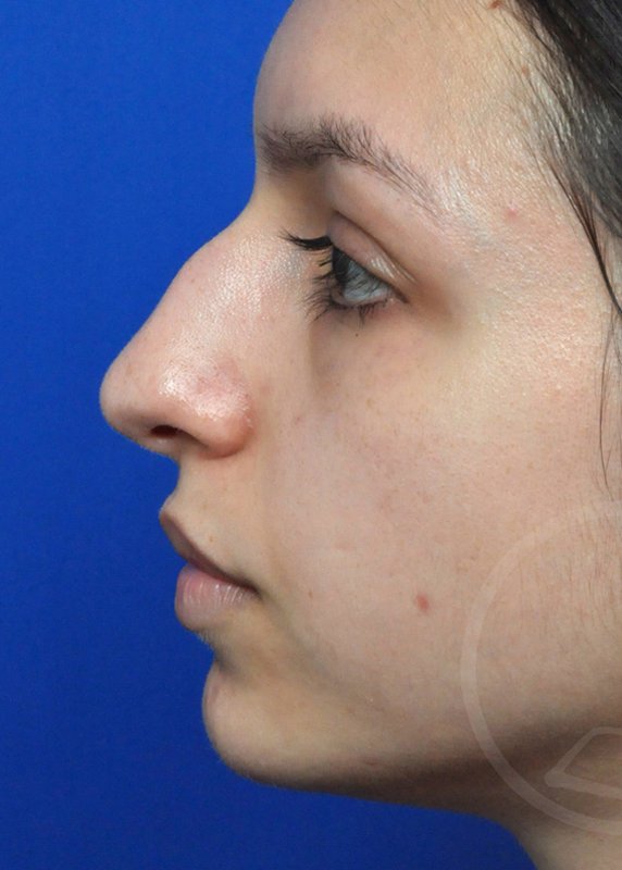 Rhinoplasty Before and After Pictures Jacksonville, FL