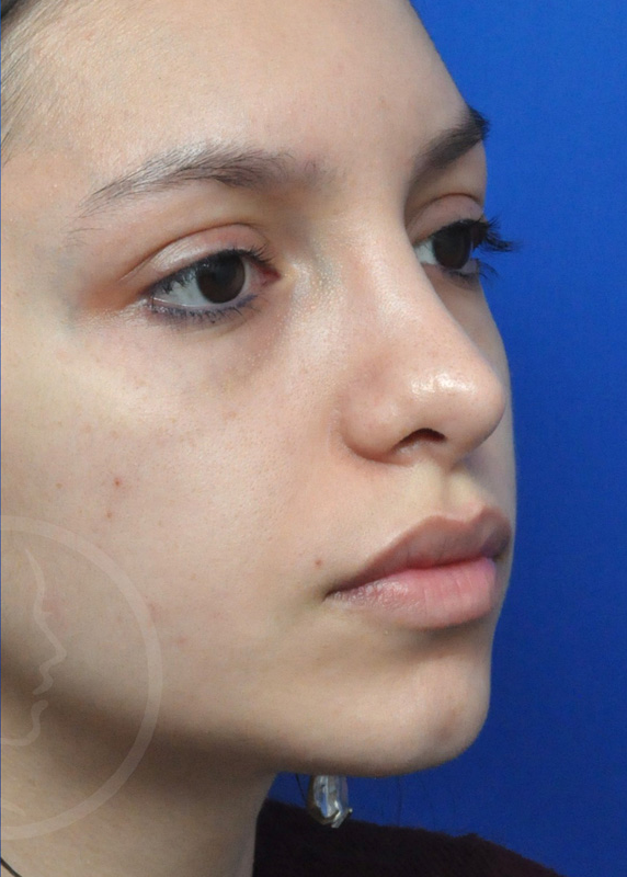 Rhinoplasty Before and After Pictures Jacksonville, FL