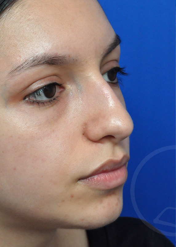 Rhinoplasty Before and After Pictures Jacksonville, FL