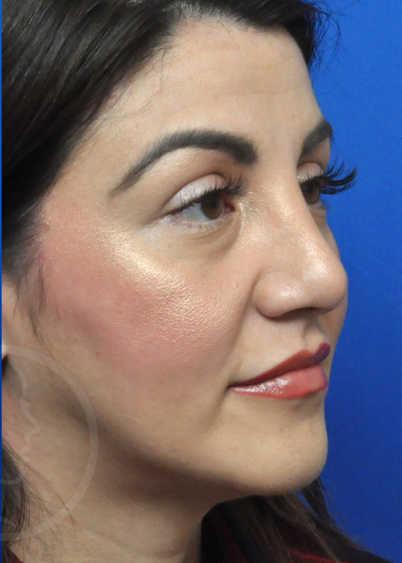 Rhinoplasty Before and After Pictures Jacksonville, FL