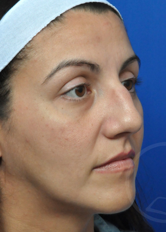 Rhinoplasty Before and After Pictures Jacksonville, FL