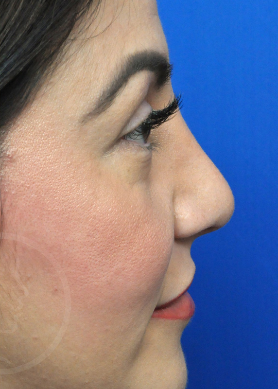 Rhinoplasty Before and After Pictures Jacksonville, FL