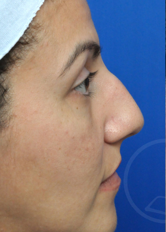 Rhinoplasty Before and After Pictures Jacksonville, FL