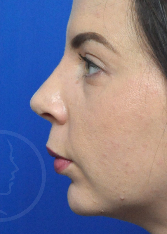 Rhinoplasty Before and After Pictures Jacksonville, FL