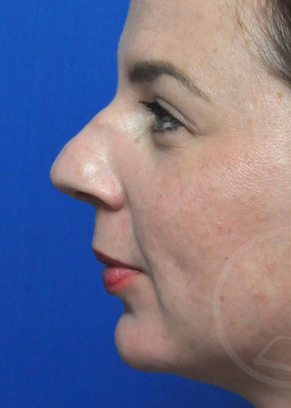 Rhinoplasty Before and After Pictures Jacksonville, FL